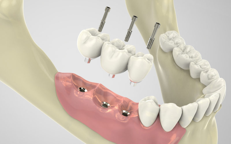 L’implantologia: una soluzione innovativa e alternativa alla vecchia dentiera